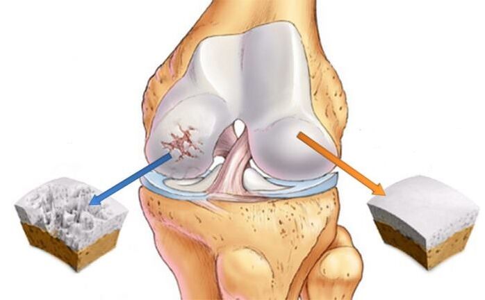 What is Arthroz