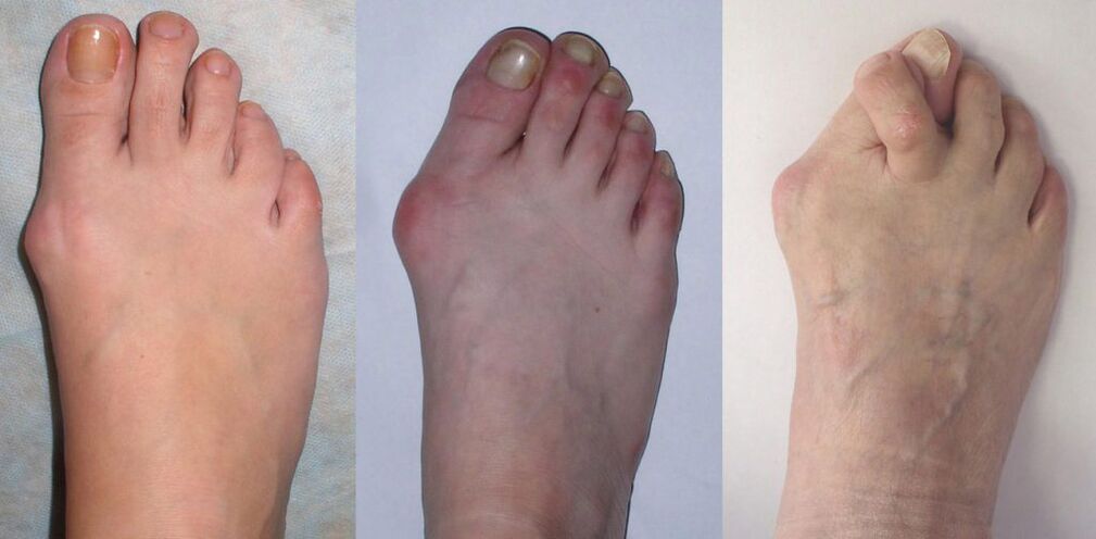 Arthritis of the leg