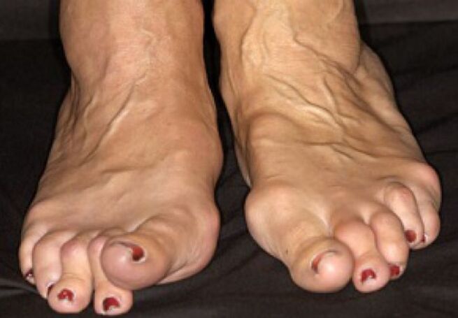 Arthrose deformation