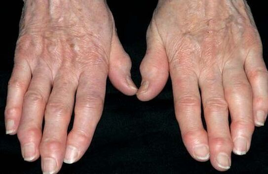 The arthra of the hands