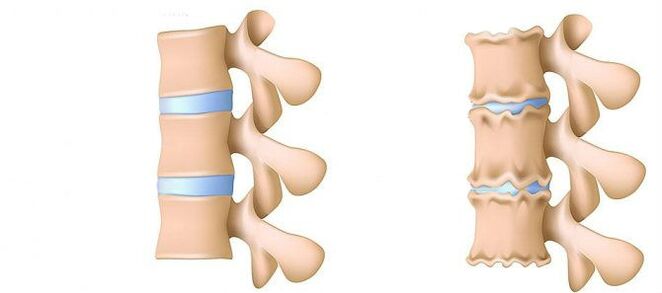 What is osteocondrosis