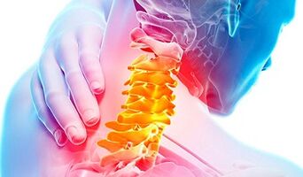 Signs of osteocondrosis of the cervical spine