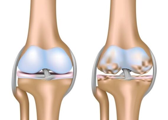 What is gonarthrosis