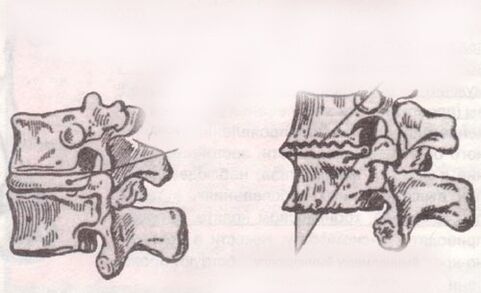 Intervertebral disk with healthy and lumbar osteocondrosis