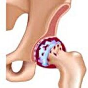 Artrosis of hip joint