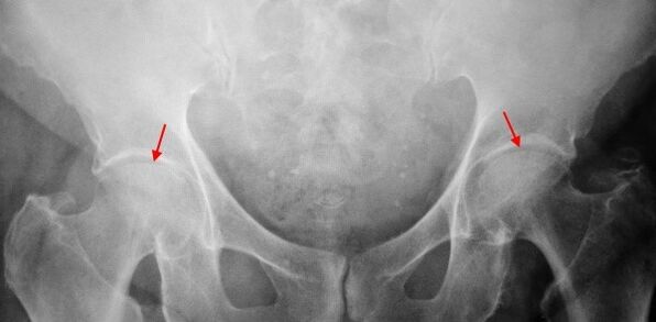 Joint space, double-sided coksartrous-support with sclerosis of articular surfaces