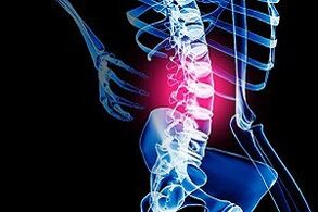 osteochondrosis of the back