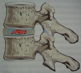 The first stage of osteochondrosis