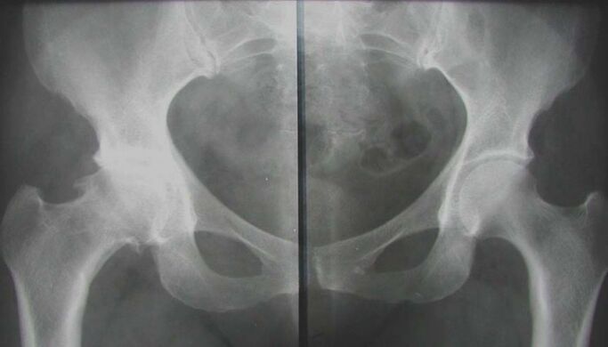 x-ray of the hip joint affected by arthrosis